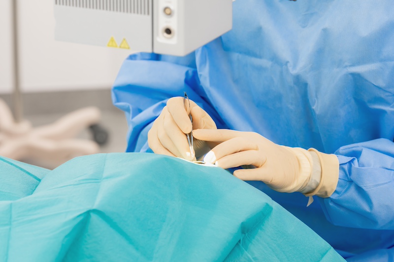 白内障手術について