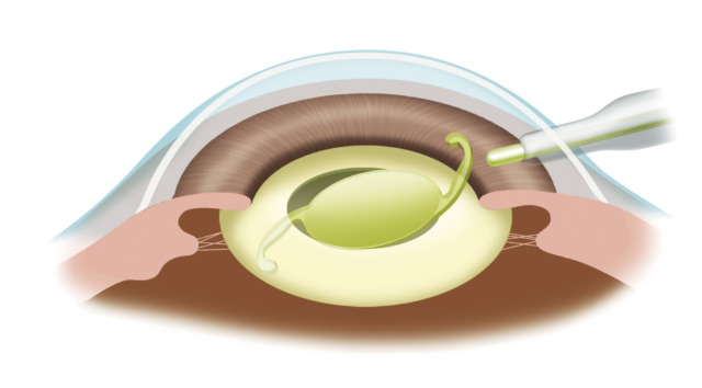 眼内レンズの挿入
