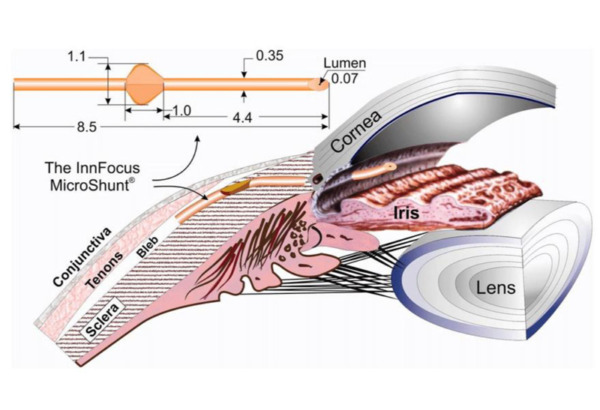 プリザーフロ®マイクロシャント手術