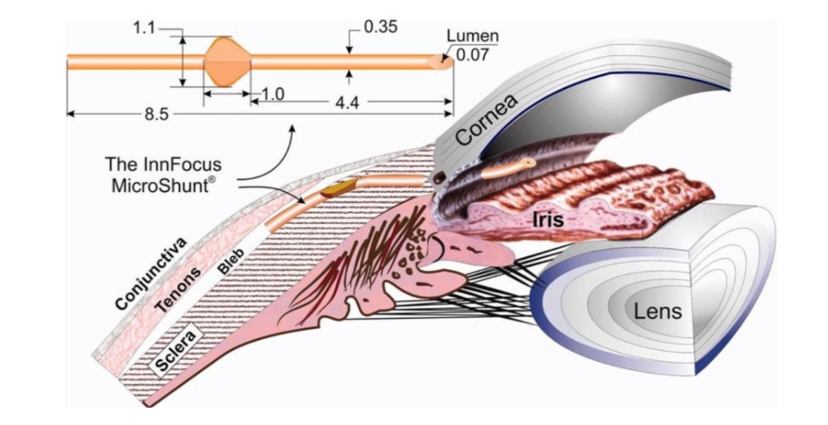 プリザーフロ®マイクロシャント